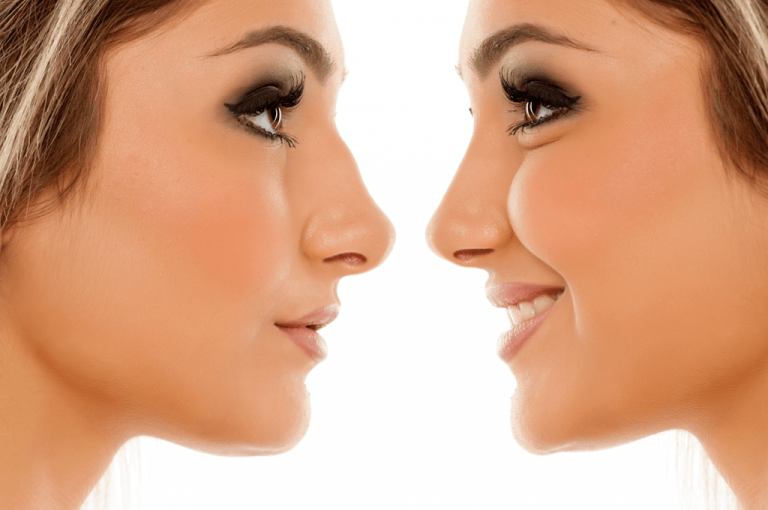 mulher sorrindo antes e depois de rinoplastia