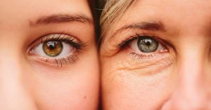 blefaroplastia antes e depois