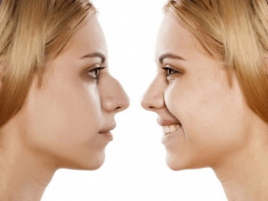 mulher mostrando Rinoplastia antes e depois