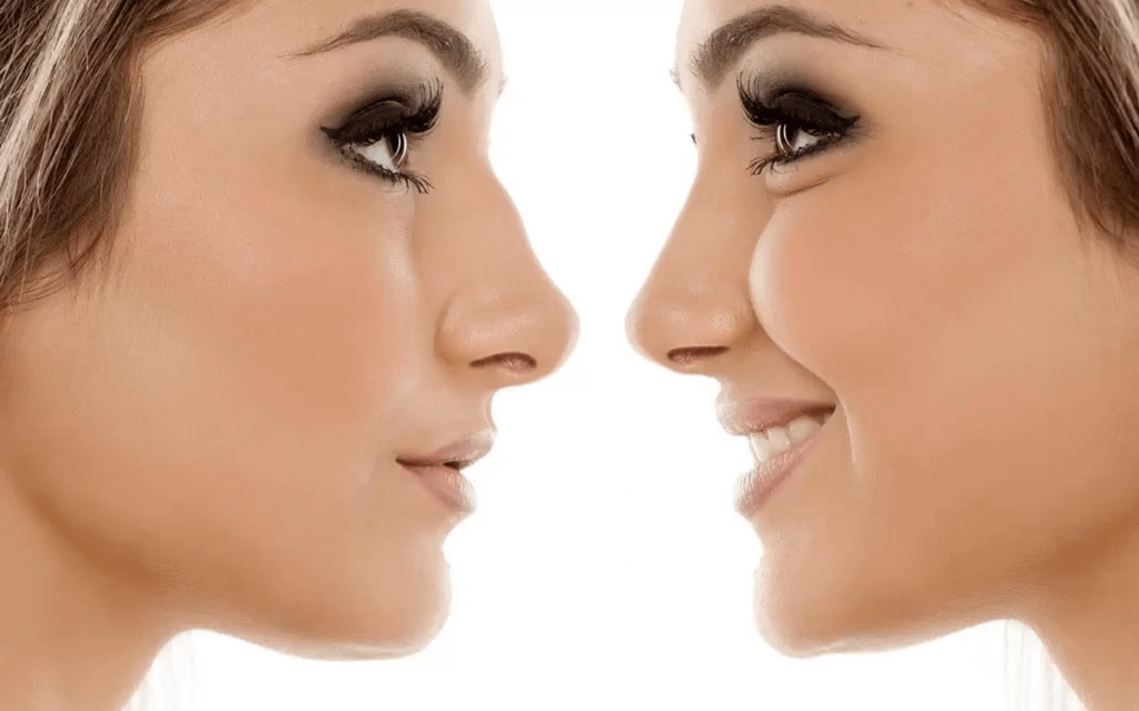 mulher demonstrando antes e depois de rinoplastia