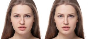 Anestesia para rinoplastia