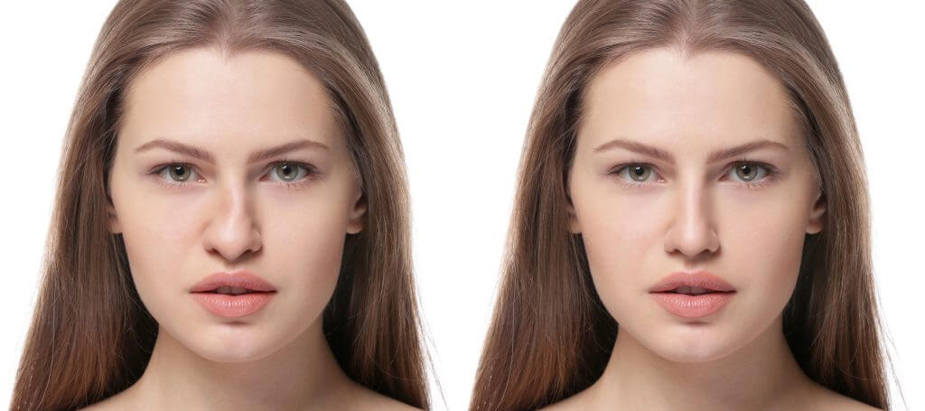 Anestesia para rinoplastia