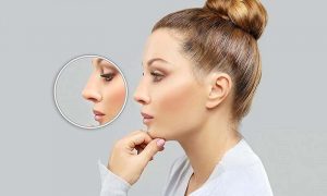 rosto de mulher de perfil demonstrando rinoplastia