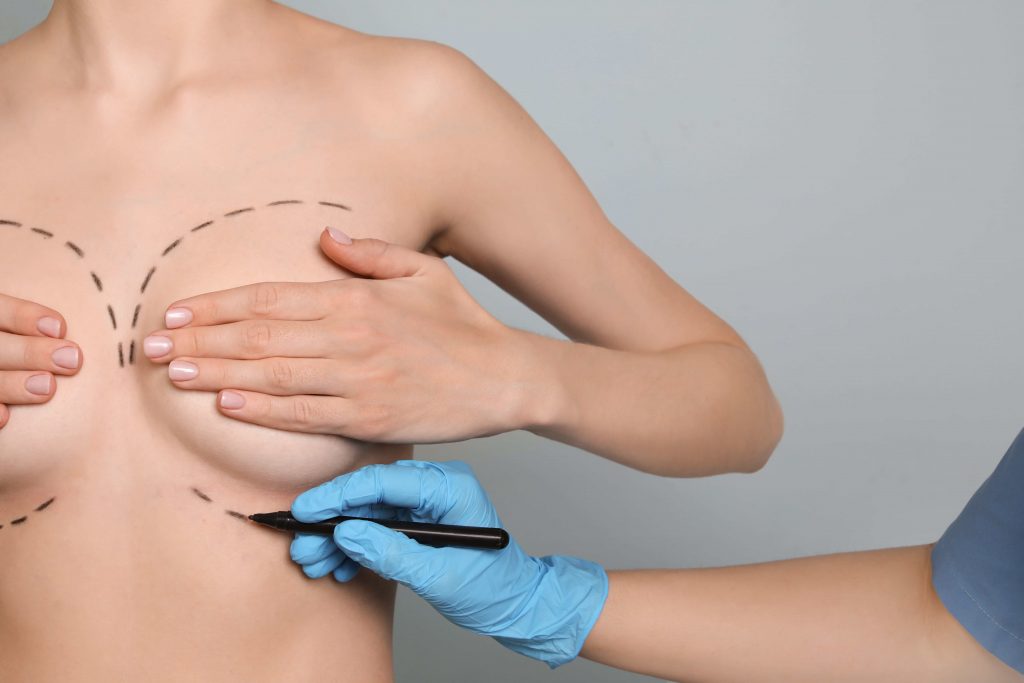 Foto doutor desenhando corpo mulher demonstrando Mastoplastia