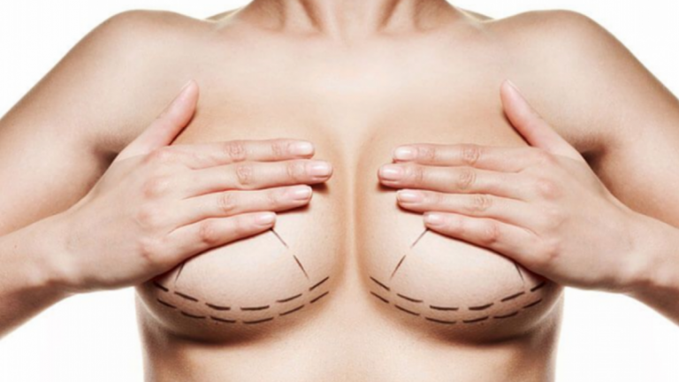 Mulher com procedimento de mamoplastia redutora - A partir de que idade posso fazer redução de mama?Entenda a mamoplastia redutora