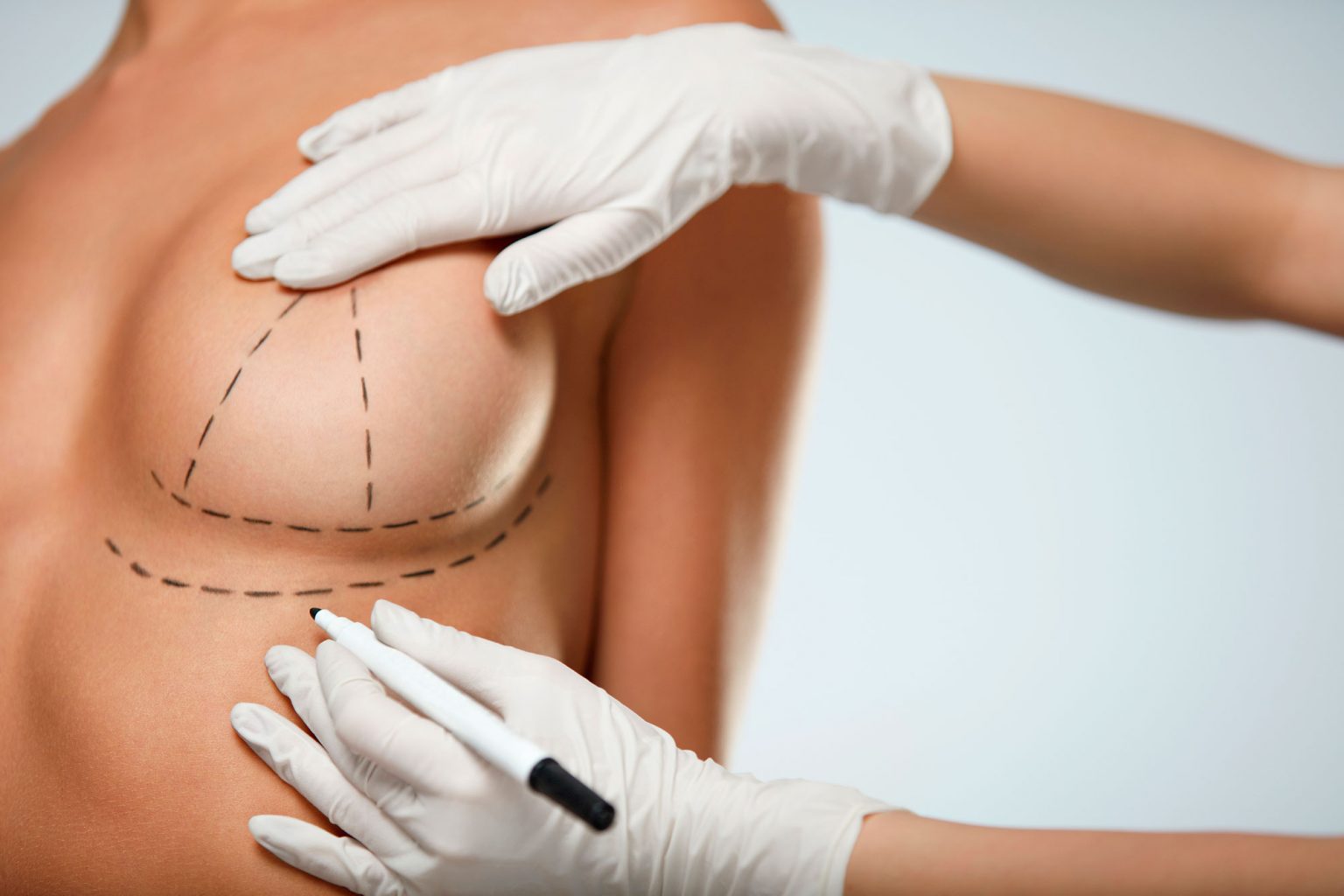 Médico demonstrando na mulher o desenho da protese de mama no corpo da paciente com linhas em caneta