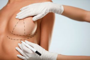 Médico demonstrando na mulher o desenho da protese de mama no corpo da paciente com linhas em caneta