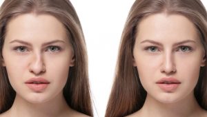 Foto de mulher demonstrando o antes e depois de rinoplastia para correção de nariz torto