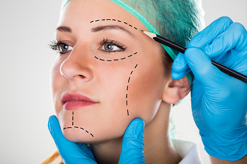 Médico desenhando no rosto de uma mulher o que vai ser feito na cirurgia plástica