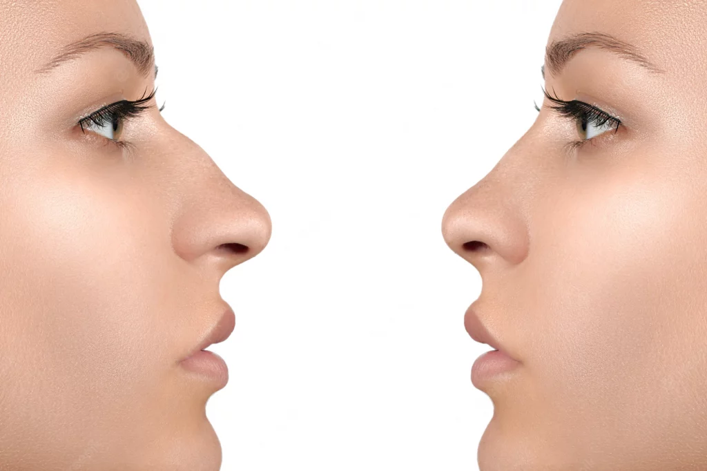 rosto-feminino-antes-depois-rinoplastia