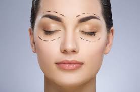 face feminina demonstrando marcações de blefaroplastia e brow lift