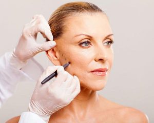 Quais os cuidados para recuperação de Facelift? mulher demonstrando lifting facial
