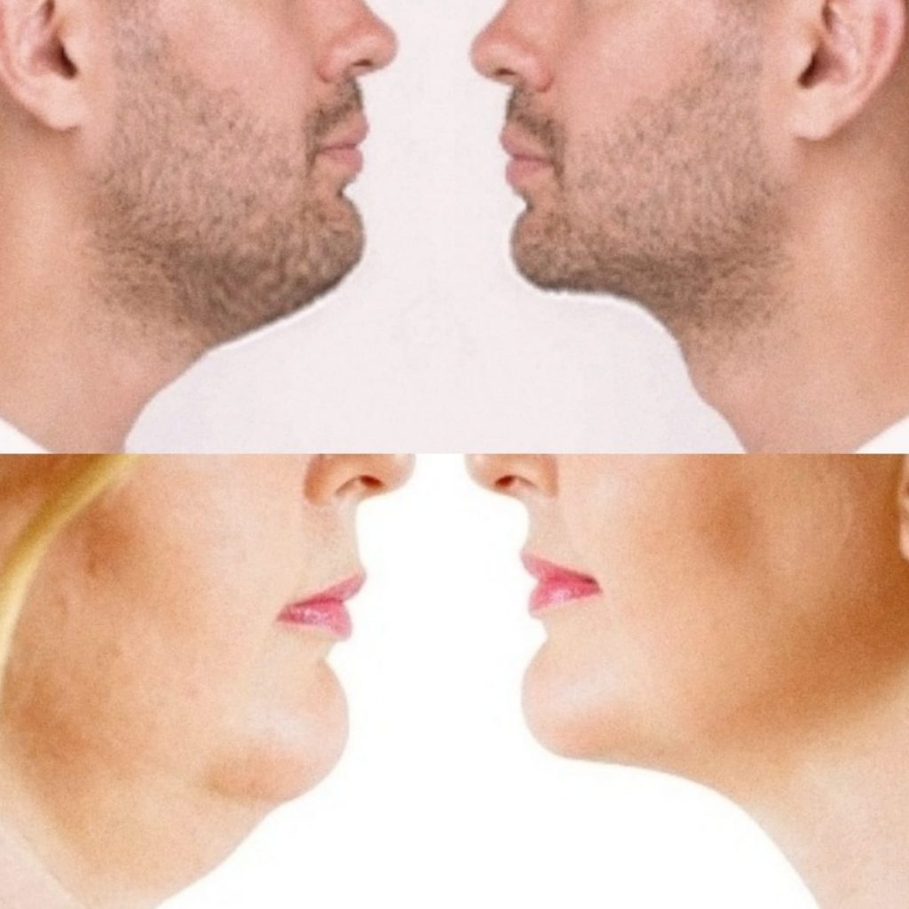 homem e mulher lipo de pescoço antes e depois