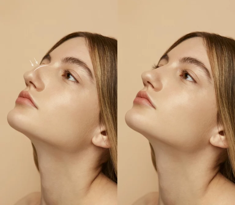 existe um nariz ideal na rinoplastia - DUAS-FACES-DE-MULHER-PARALELAS-ANTES-E-DEPOIS-DA-RINOPLASTIA