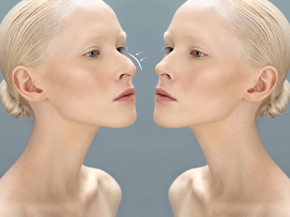 mulher loira bem clara em duas fotos uma frente a outra mostrando o antes e depois da Rinoplastia