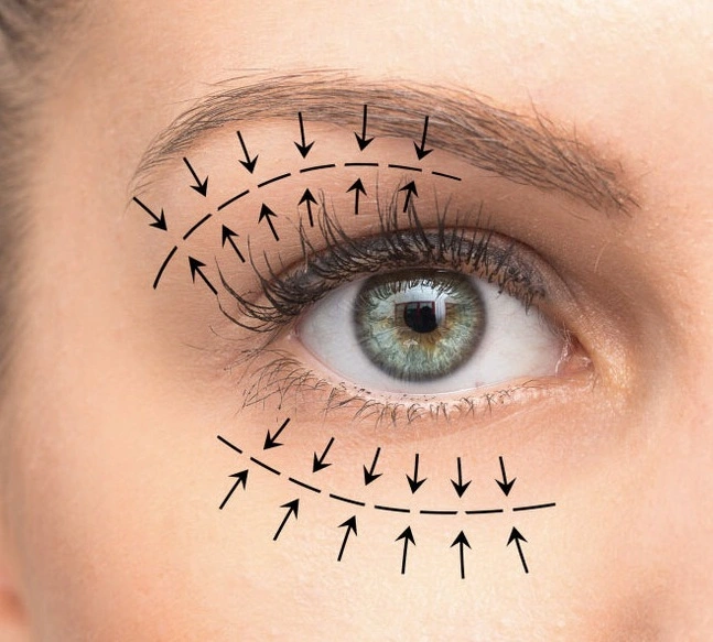 olho feminino mostrando blefaroplastia com desenho de setas