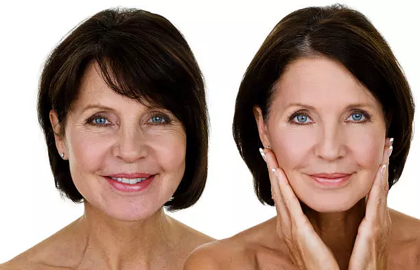 rosto-de-mulher-bonita-mais-de-55-anos-antes-e-depois-Lifting-facial