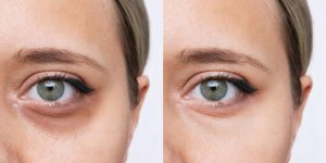 foto de olho feminino antes e depis de blefaroplastia